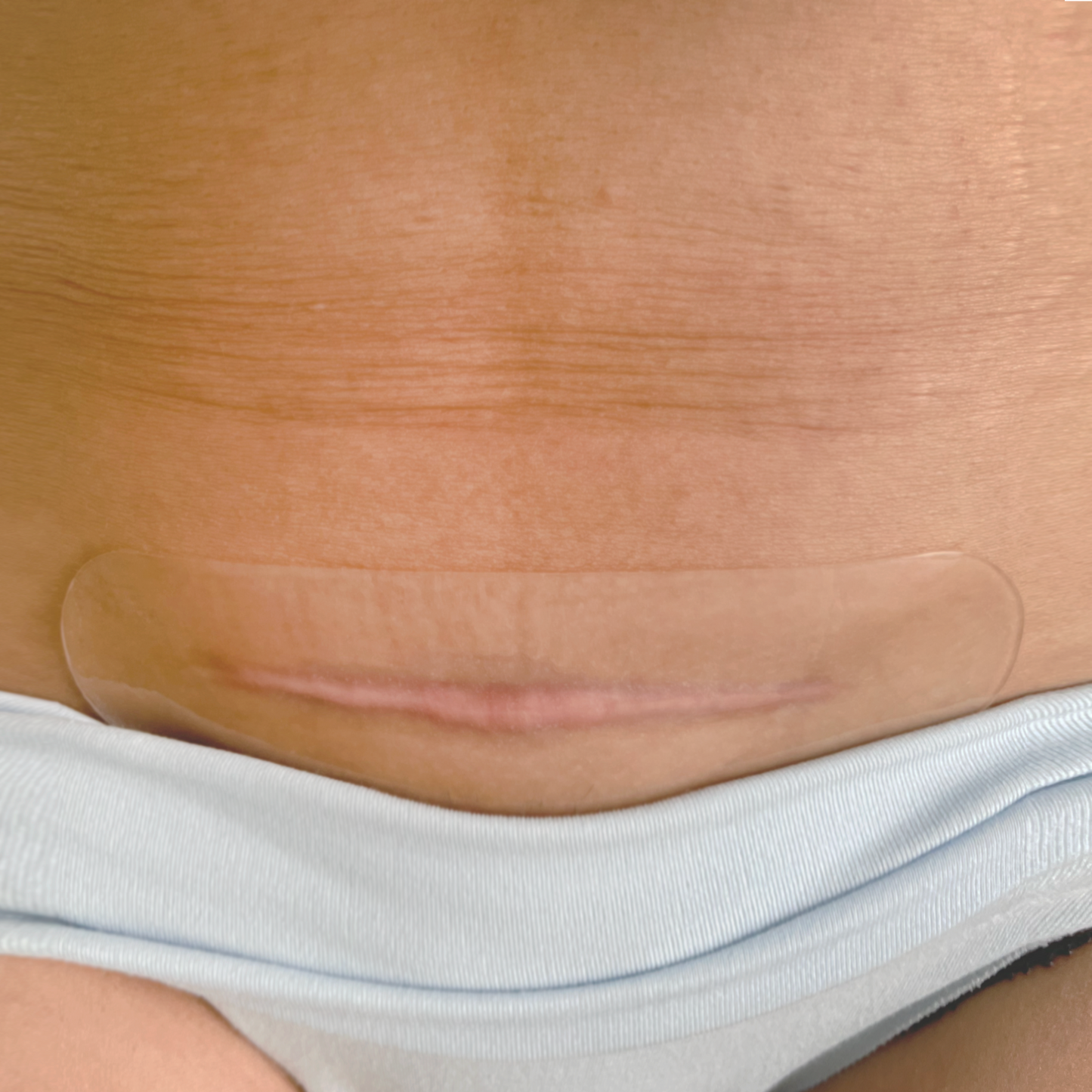 Silicone C-section Scar Patch